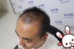 -大麦微针植发丨全国连锁