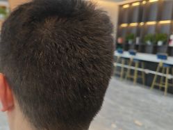 -碧莲盛·不剃发植发