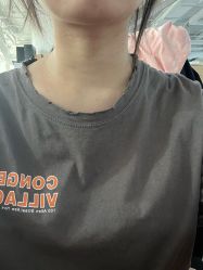 体验后-丰联丽格医疗美容·联合丽格眼整形中心