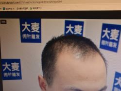-大麦微针植发丨全国连锁