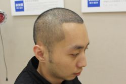 -大麦微针植发丨全国连锁