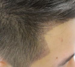 -大麦微针植发全国连锁