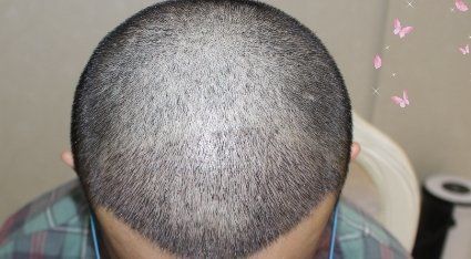 -大麦微针植发丨全国连锁