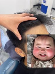 -大麦微针植发全国连锁