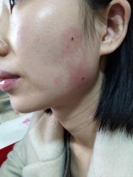 -北京美痣堂古方祛痣斑疣瘊
