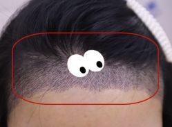 -大麦微针植发全国连锁