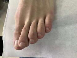 -德哥灰指甲脚气甲沟炎跖疣护理