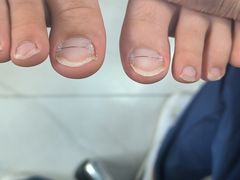 -Andrew指甲专科灰指甲·甲沟炎矫正·3D步态矫形鞋垫定制(浦三路店)