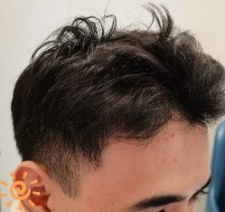 -大麦微针植发丨全国连锁