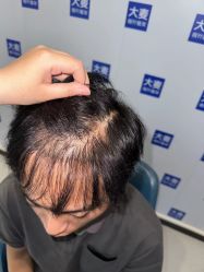 -大麦微针植发丨全国连锁