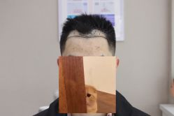 体验前-大麦微针植发全国连锁