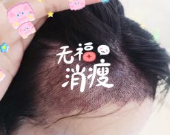 -大麦微针植发全国连锁