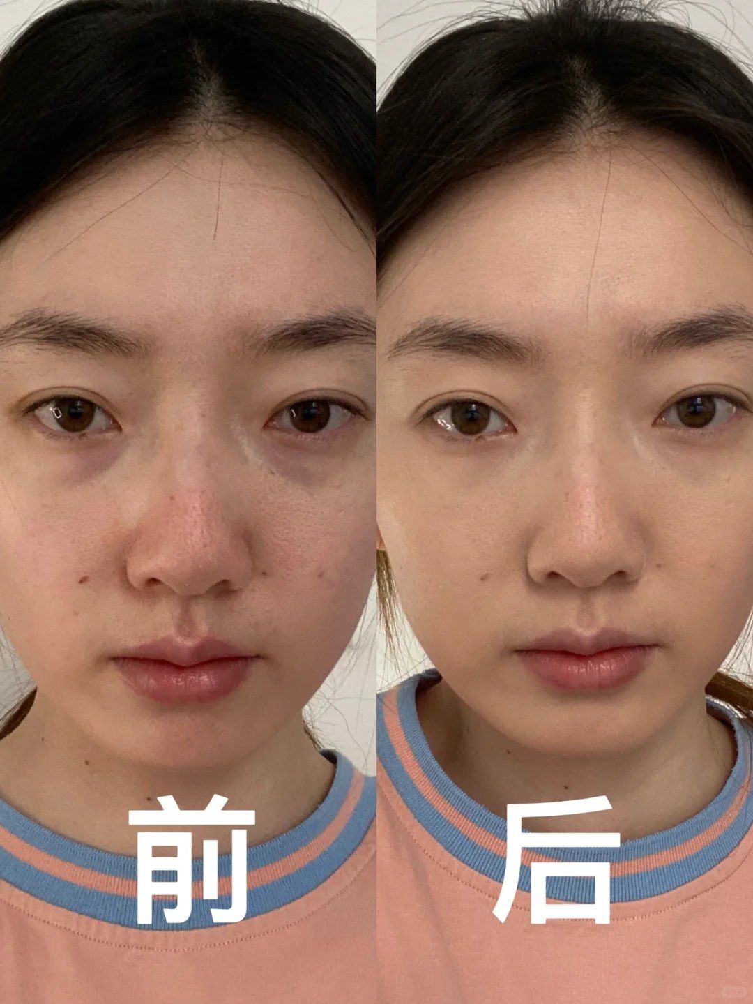 泪沟黑眼圈一搞一个不吱声