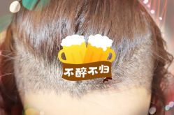 -大麦微针植发全国连锁