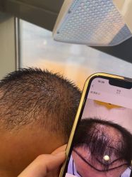 -碧莲盛·不剃发植发