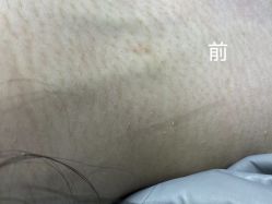 -爱莎扁平疣·汗管瘤·斑痣中心