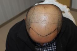 -大麦微针植发丨全国连锁