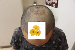 -大麦微针植发丨全国连锁