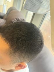 -碧莲盛·不剃发植发