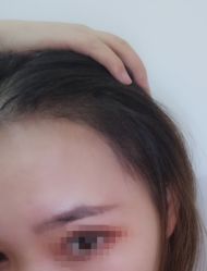 -大麦微针植发丨全国连锁