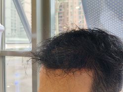 -碧莲盛·不剃发植发