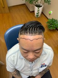 -大麦微针植发全国连锁