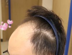 -大麦微针植发全国连锁