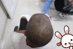 -大麦微针植发丨全国连锁