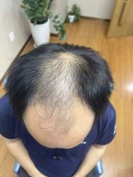 -大麦微针植发全国连锁