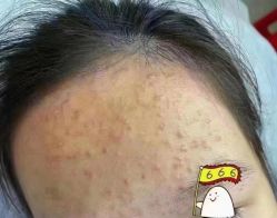 -蕾特恩专业祛痘国际连锁