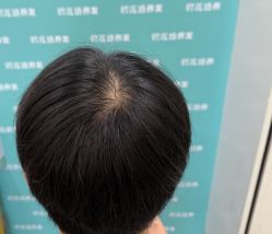 -碧莲盛·不剃发植发