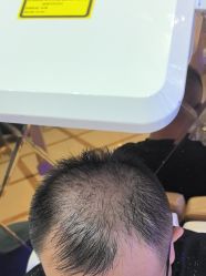 -碧莲盛·不剃发植发