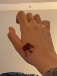 -一次性洗纹身·修复疤痕·超皮秒
