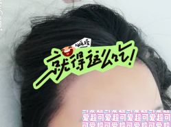 -大麦微针植发全国连锁