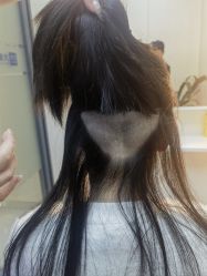 -大麦微针植发全国连锁