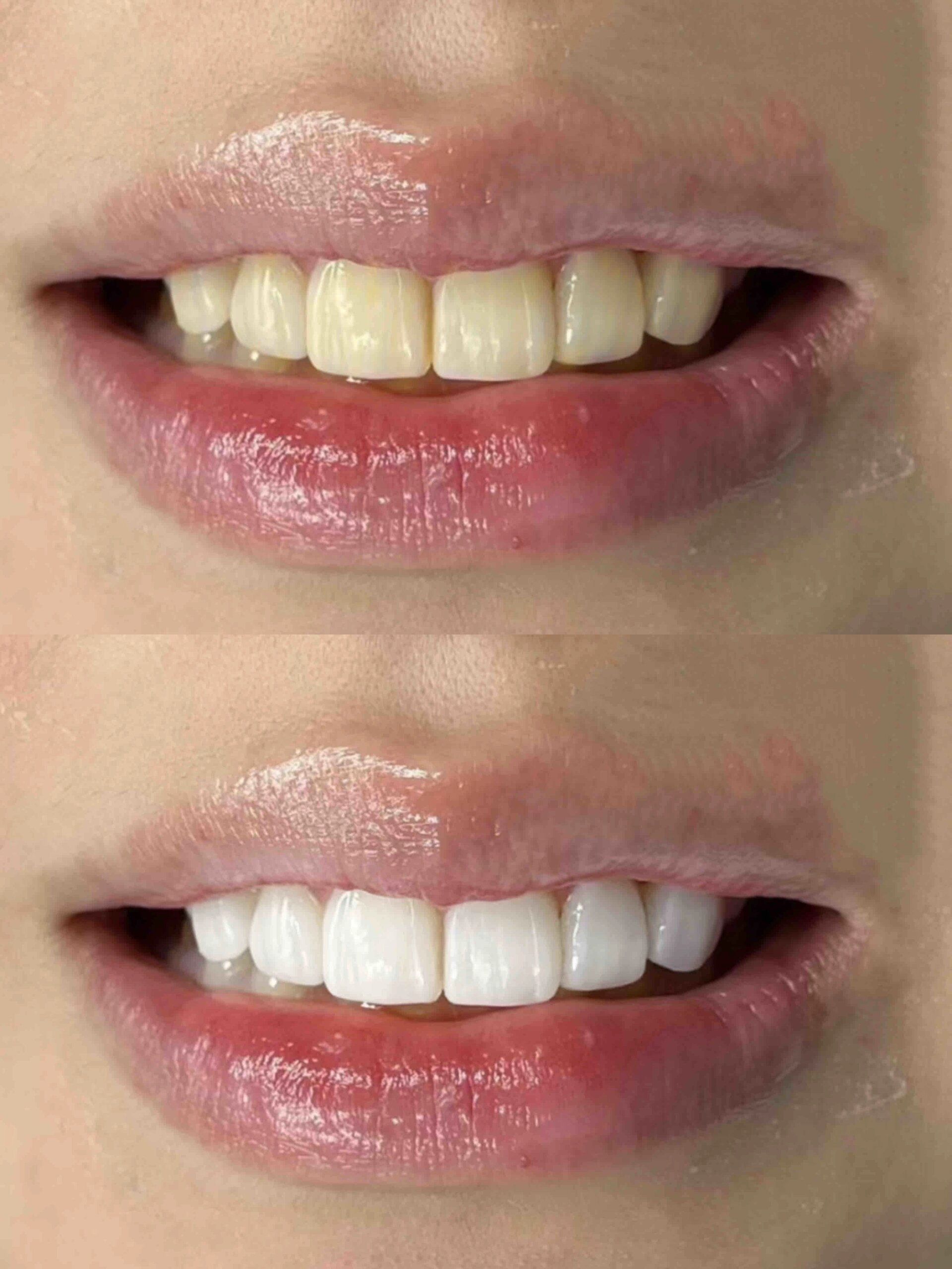 把我的牙齿洗白了.
希望牙黄的宝子们都能成功上岸!