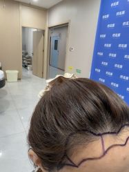 -碧莲盛不剃发植发