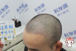 -大麦微针植发丨全国连锁