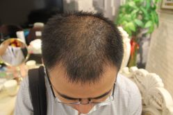 -大麦微针植发丨全国连锁