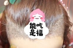 -大麦微针植发全国连锁