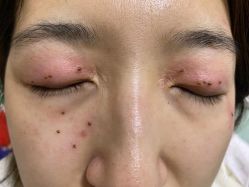 -北京美痣堂古方祛痣斑疣瘊
