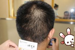 -大麦微针植发丨全国连锁