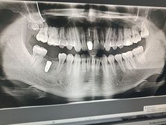 -上海仁爱医院口腔科 · 种植