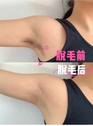 -薇兰专业脱毛连锁机构