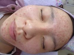 -苗老祖痘敏斑激素脸问题皮肤修复中心