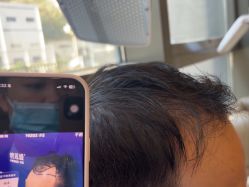 -碧莲盛·不剃发植发