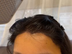 -碧莲盛·不剃发植发