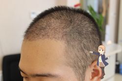 -大麦微针植发丨全国连锁