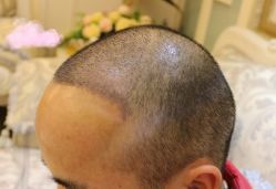 -大麦微针植发丨全国连锁