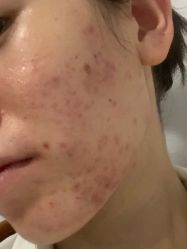 -悟空祛痘·诺奖技术专业店